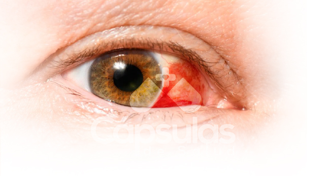 Derrame Subconjuntival