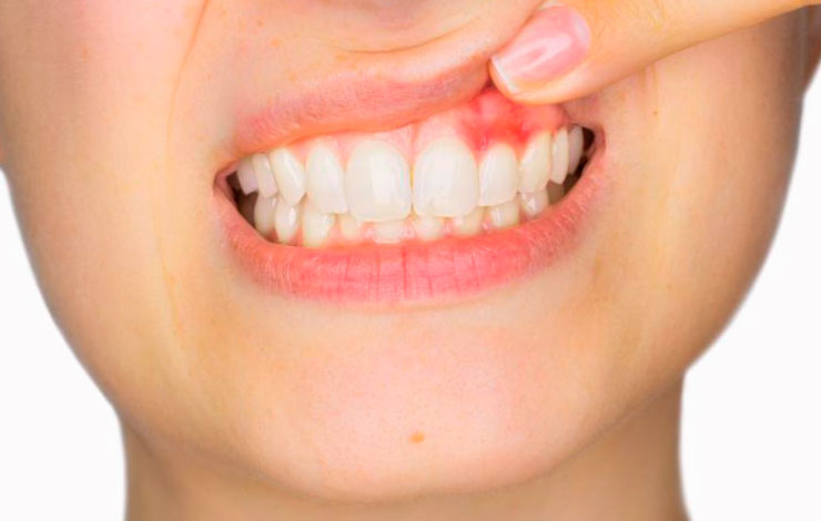 La Gingivitis